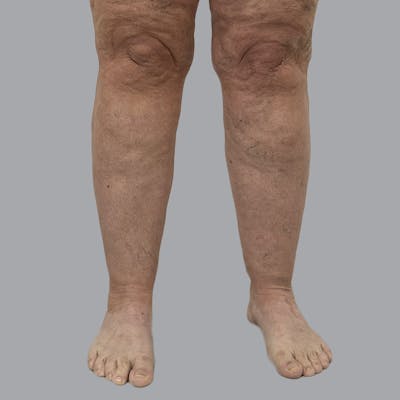 Lipedema Before & After Gallery - Patient 135752 - Image 1