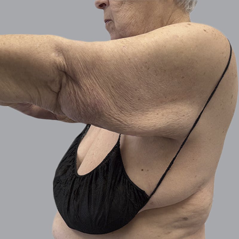 Lipedema Before & After Gallery - Patient 421876 - Image 4
