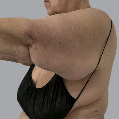 Lipedema Before & After Gallery - Patient 421876 - Image 5