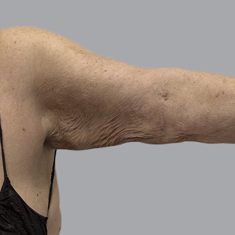 Lipedema Before & After Gallery - Patient 421876 - Image 2