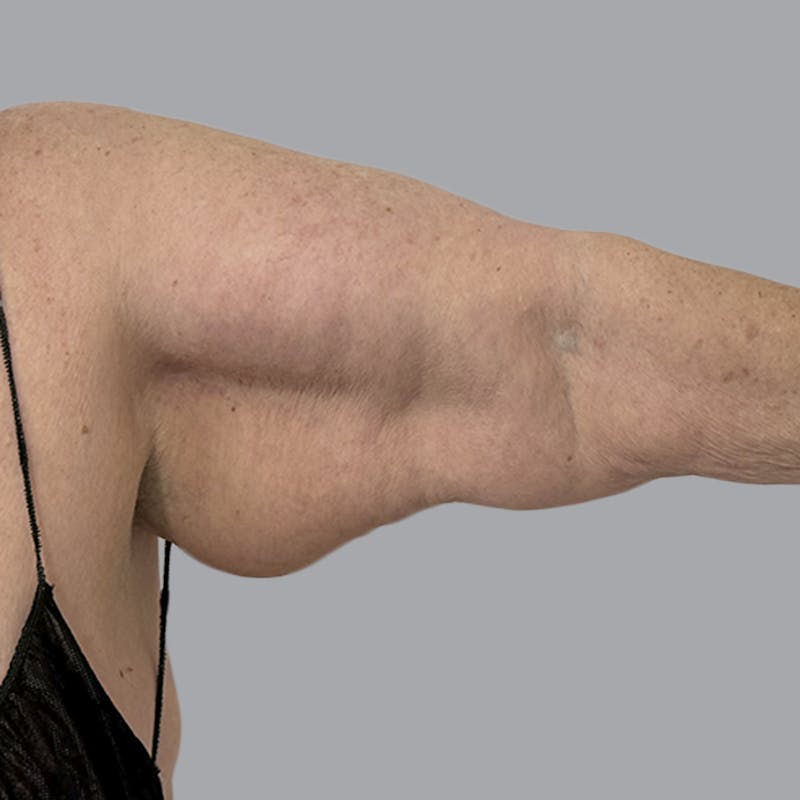 Lipedema Before & After Gallery - Patient 421876 - Image 1