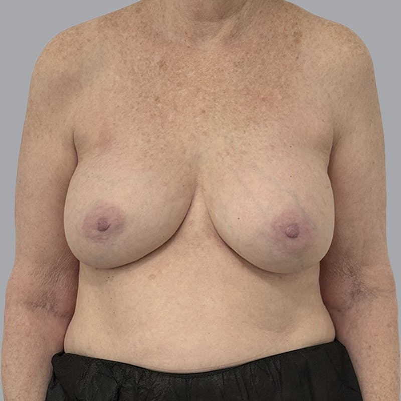 Breast Implant Removal Before & After Gallery - Patient 310939 - Image 1