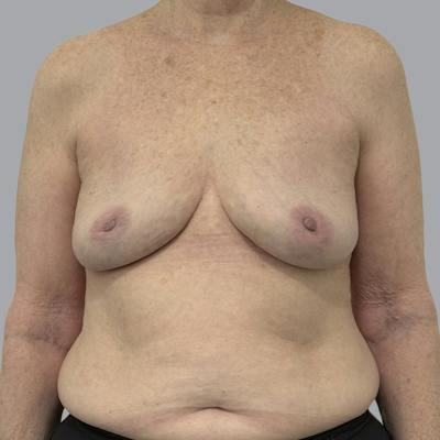 Breast Implant Removal Before & After Gallery - Patient 310939 - Image 2