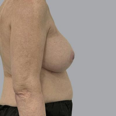 Breast Implant Removal Before & After Gallery - Patient 310939 - Image 5