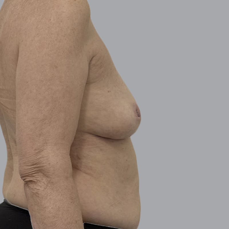 Breast Implant Removal Before & After Gallery - Patient 310939 - Image 6