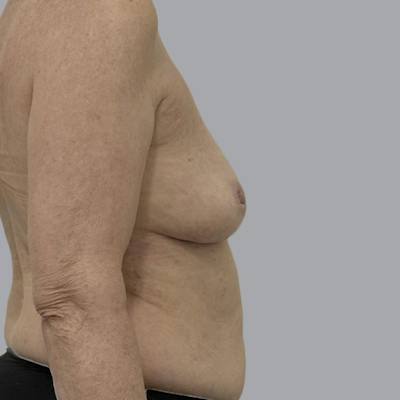 Breast Implant Removal Before & After Gallery - Patient 310939 - Image 6