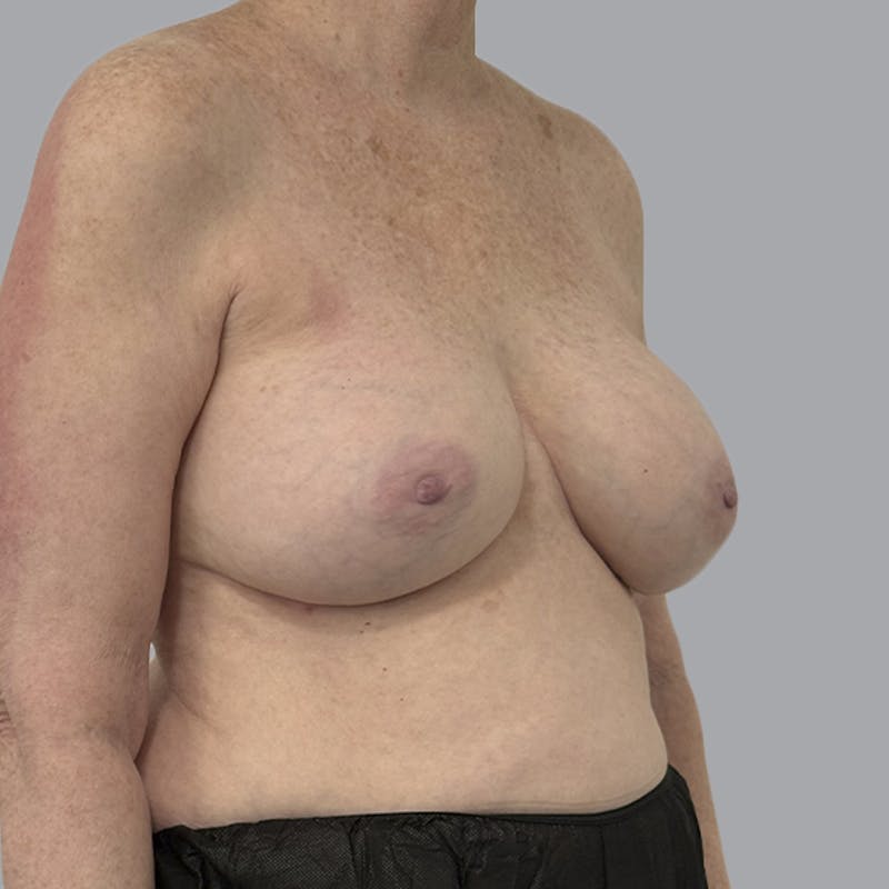 Breast Implant Removal Before & After Gallery - Patient 310939 - Image 3
