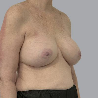 Breast Implant Removal Before & After Gallery - Patient 310939 - Image 3