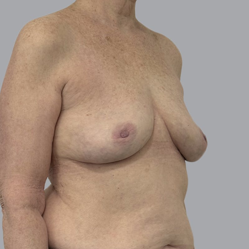 Breast Implant Removal Before & After Gallery - Patient 310939 - Image 4