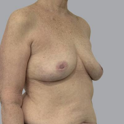 Breast Implant Removal Before & After Gallery - Patient 310939 - Image 4