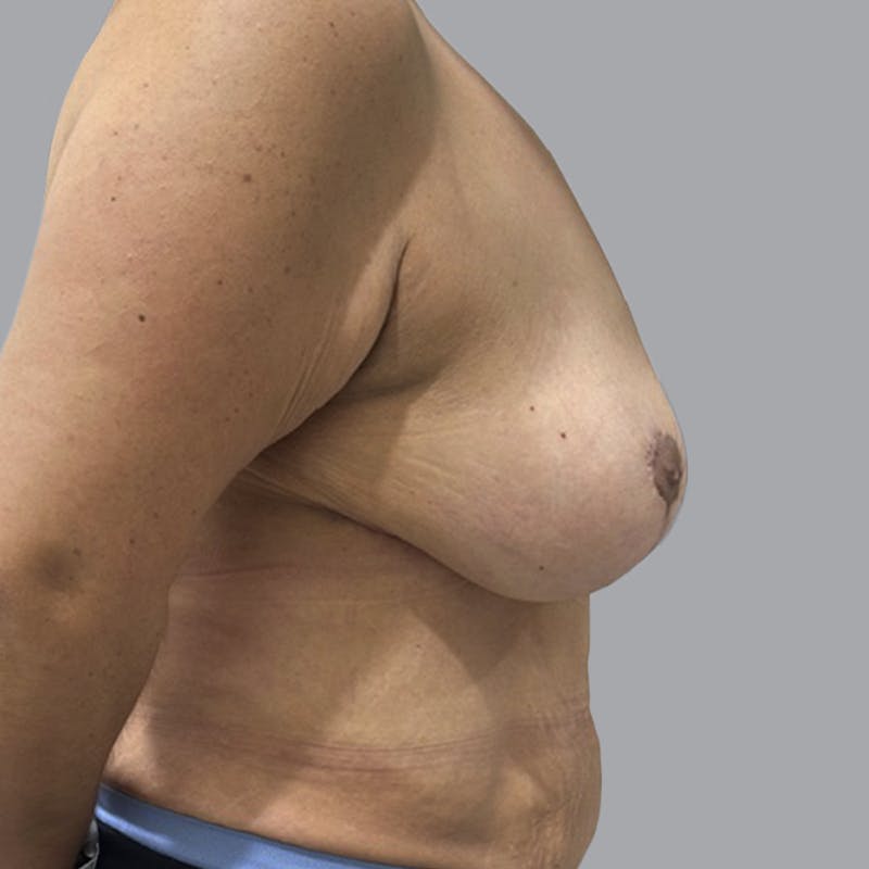 Breast Lift Before & After Gallery - Patient 286215 - Image 4