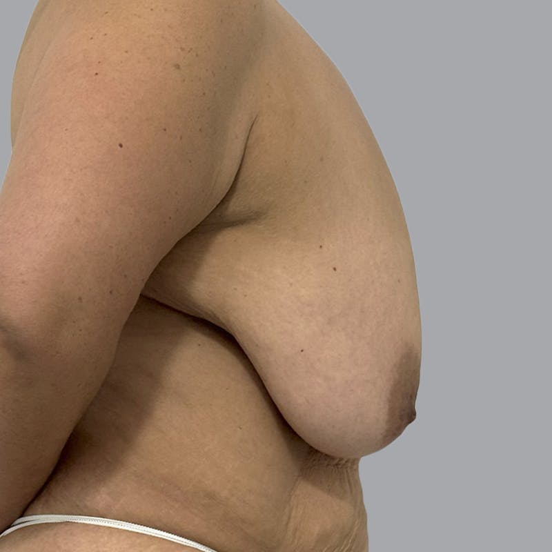 Breast Lift Before & After Gallery - Patient 286215 - Image 3