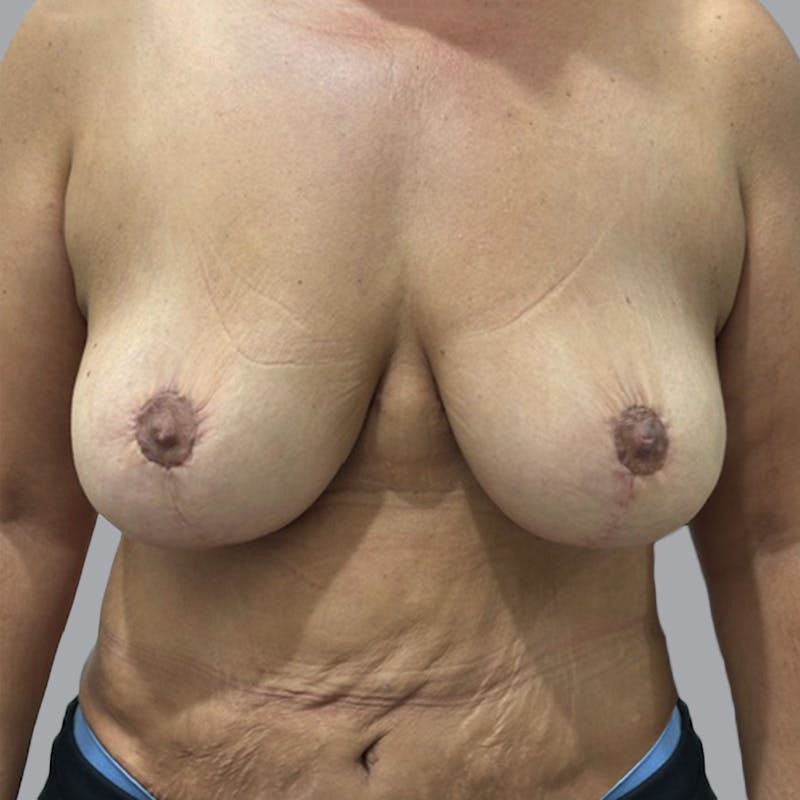 Breast Lift Before & After Gallery - Patient 286215 - Image 2