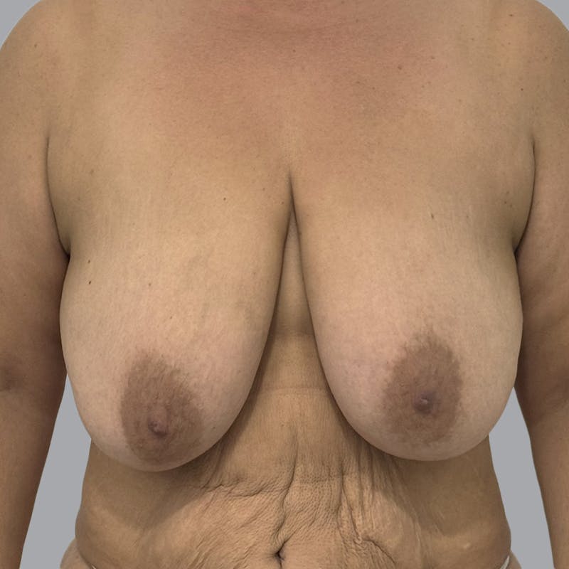 Breast Lift Before & After Gallery - Patient 286215 - Image 1