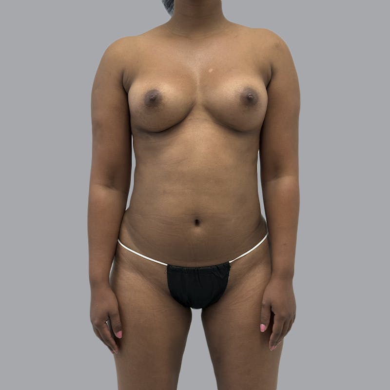 Breast Augmentation with Fat Transfer Before & After Gallery - Patient 243197 - Image 2