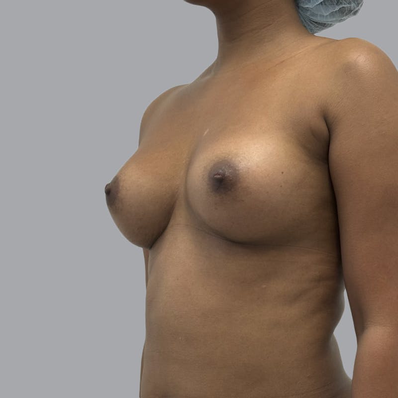 Breast Augmentation with Fat Transfer Before & After Gallery - Patient 243197 - Image 4