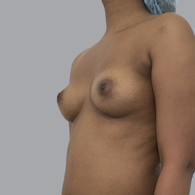 Breast Augmentation with Fat Transfer Before & After Gallery - Patient 243197 - Image 3