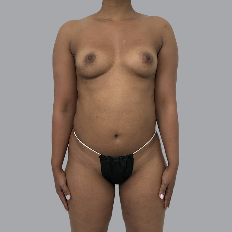 Breast Augmentation with Fat Transfer Before & After Gallery - Patient 243197 - Image 1