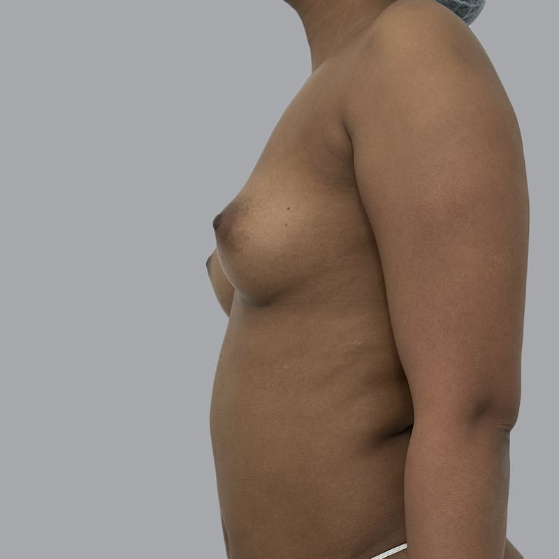 Breast Augmentation with Fat Transfer Before & After Gallery - Patient 243197 - Image 5