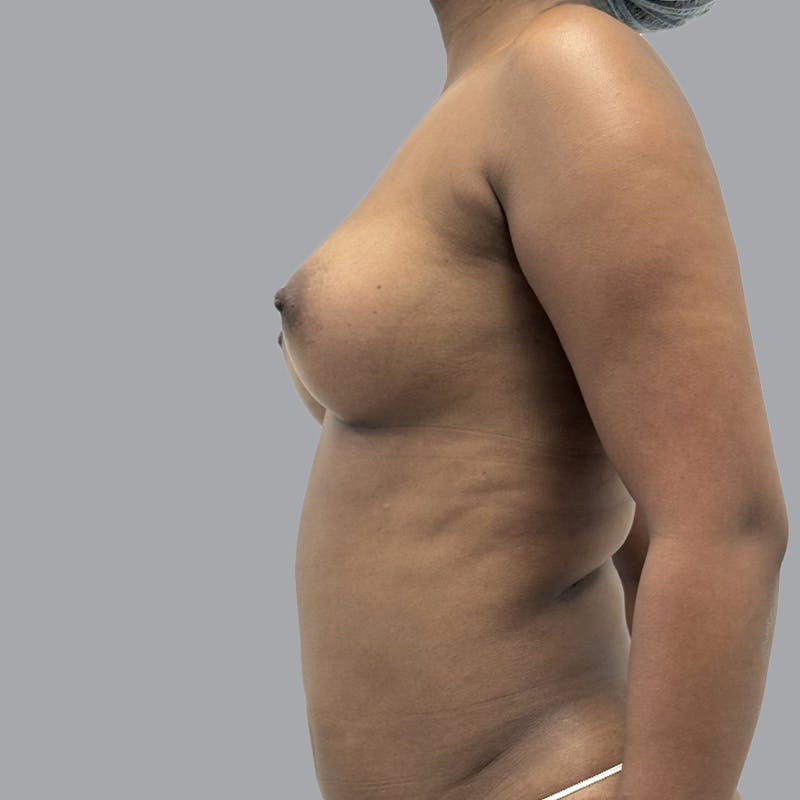 Breast Augmentation with Fat Transfer Before & After Gallery - Patient 243197 - Image 6