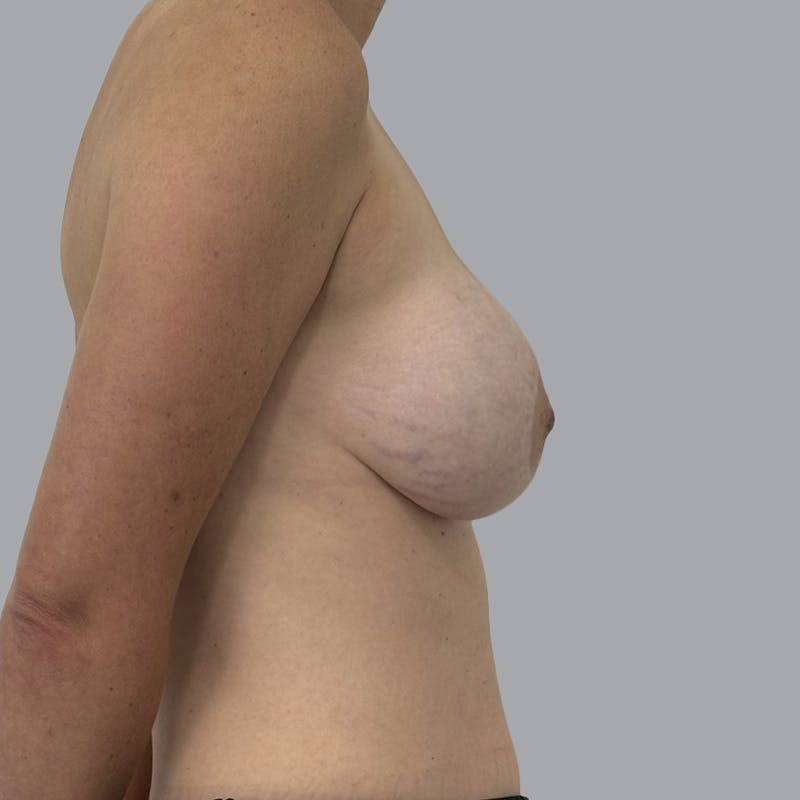 Breast Implant Removal Before & After Gallery - Patient 651224 - Image 3