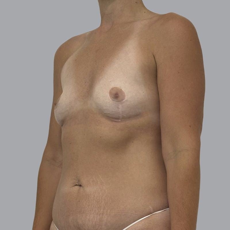 Breast Augmentation with Fat Transfer Before & After Gallery - Patient 284677 - Image 5