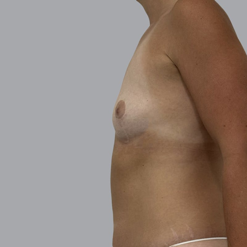Breast Augmentation with Fat Transfer Before & After Gallery - Patient 284677 - Image 3