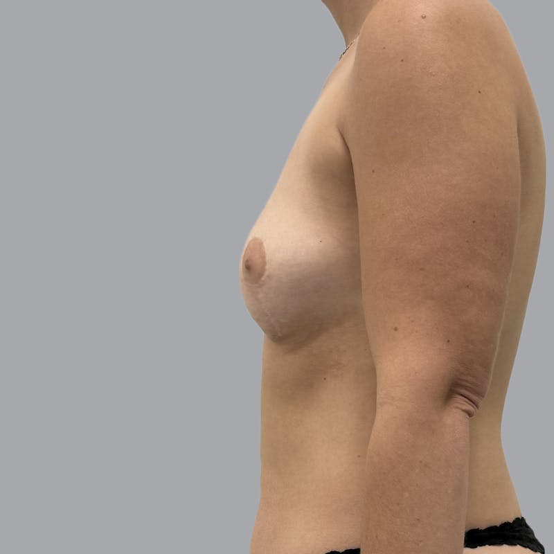 Breast Augmentation with Fat Transfer Before & After Gallery - Patient 284677 - Image 4