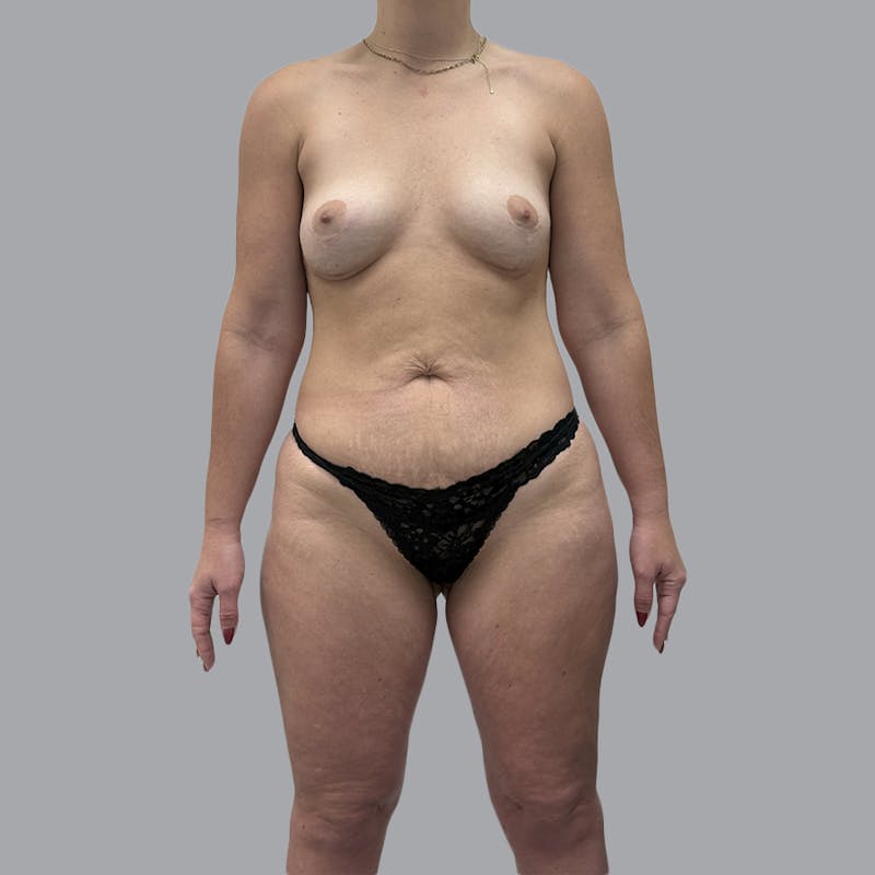 Breast Augmentation with Fat Transfer Before & After Gallery - Patient 284677 - Image 2