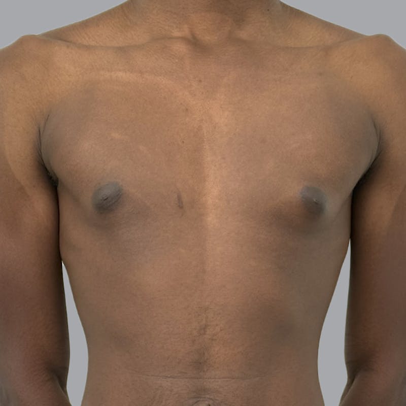 Gynecomastia Before & After Gallery - Patient 259962 - Image 1