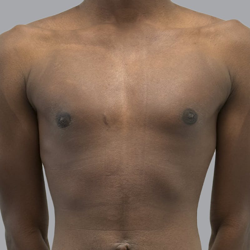 Gynecomastia Before & After Gallery - Patient 259962 - Image 2