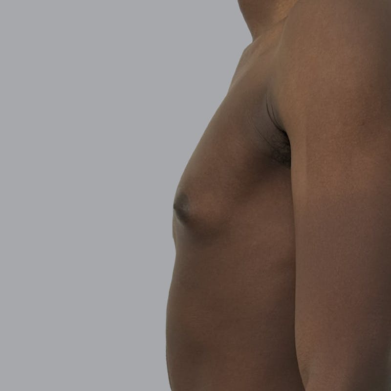Gynecomastia Before & After Gallery - Patient 259962 - Image 5