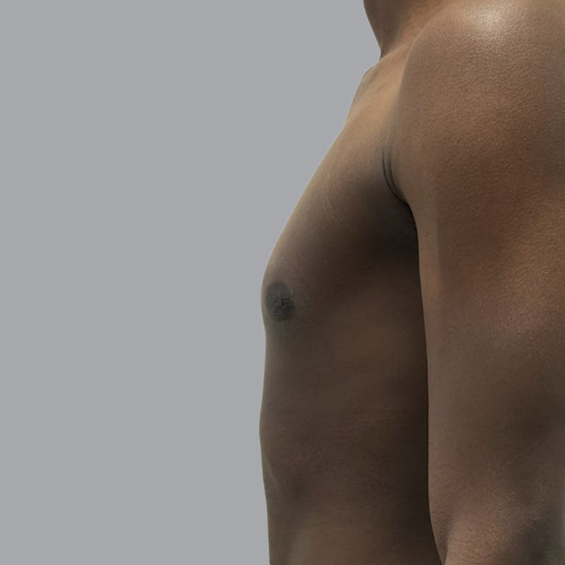 Gynecomastia Before & After Gallery - Patient 259962 - Image 6