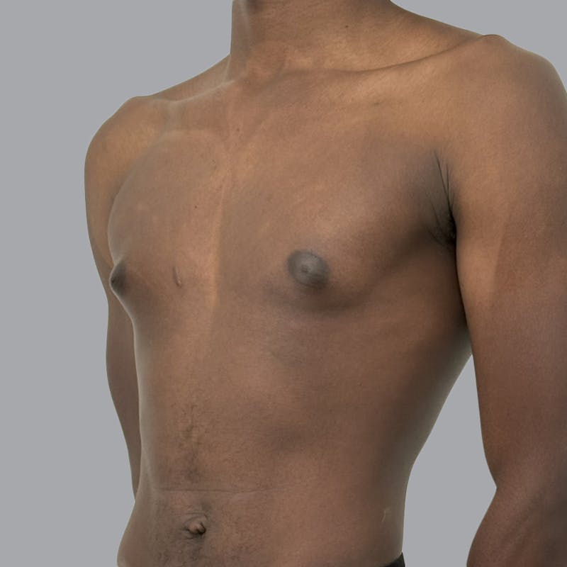 Gynecomastia Before & After Gallery - Patient 259962 - Image 3