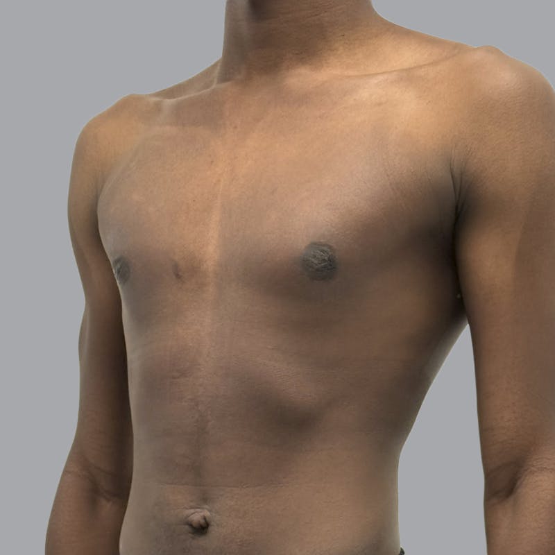 Gynecomastia Before & After Gallery - Patient 259962 - Image 4