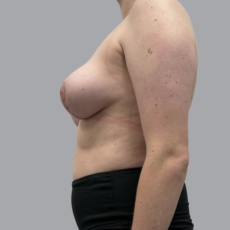 Breast Reduction Before & After Gallery - Patient 182254 - Image 6