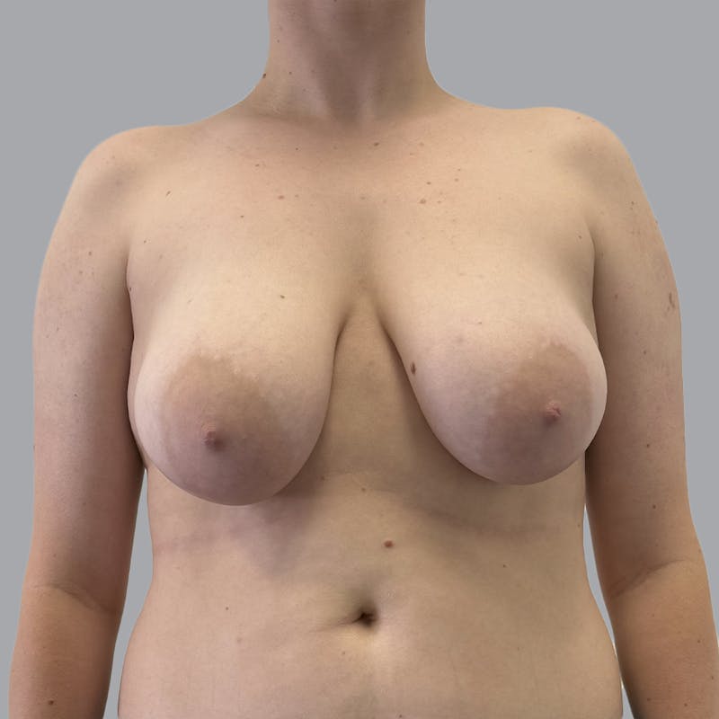 Breast Reduction Before & After Gallery - Patient 182254 - Image 1