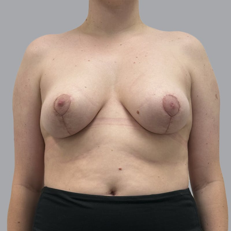Breast Reduction Before & After Gallery - Patient 182254 - Image 2