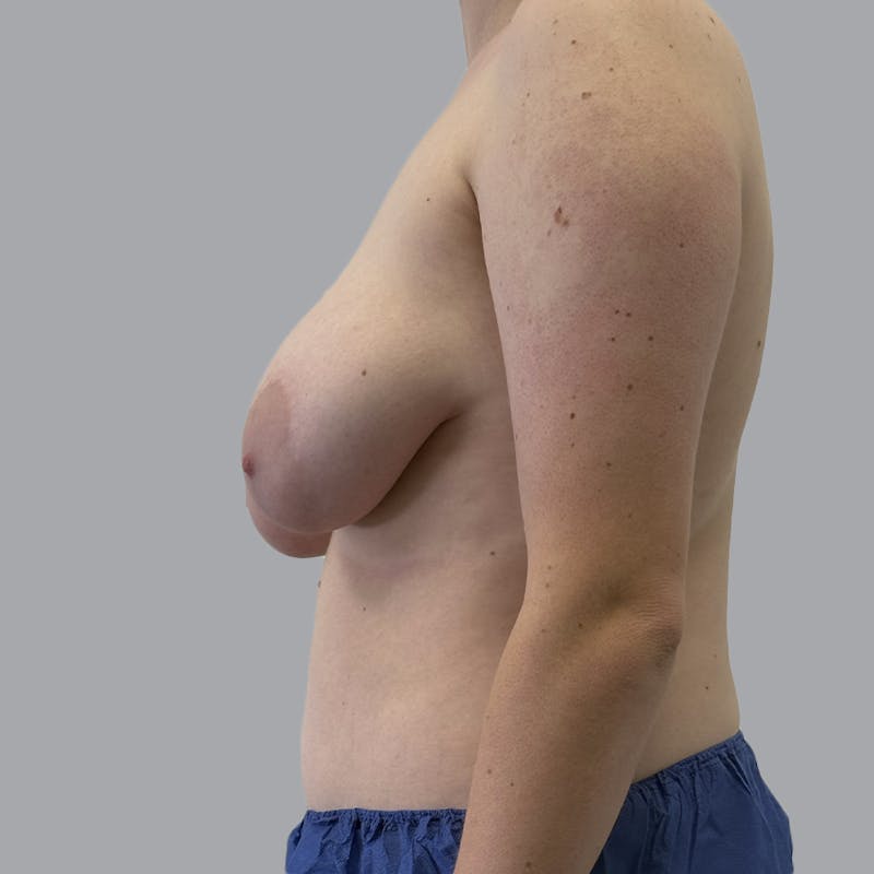 Breast Reduction Before & After Gallery - Patient 182254 - Image 5