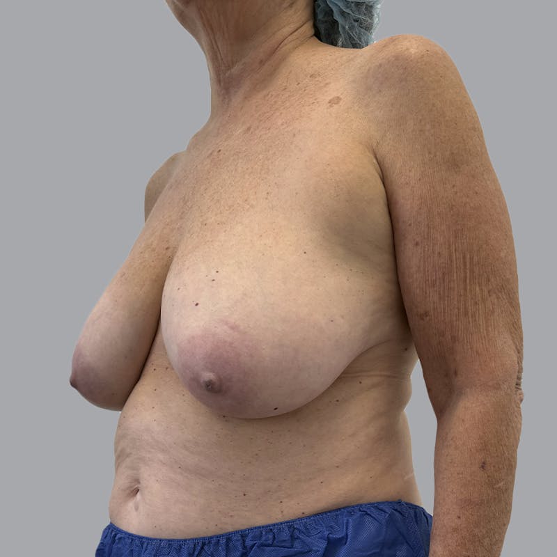 Breast Reduction Before & After Gallery - Patient 126012 - Image 5