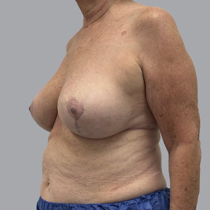 Breast Reduction Before & After Gallery - Patient 126012 - Image 6