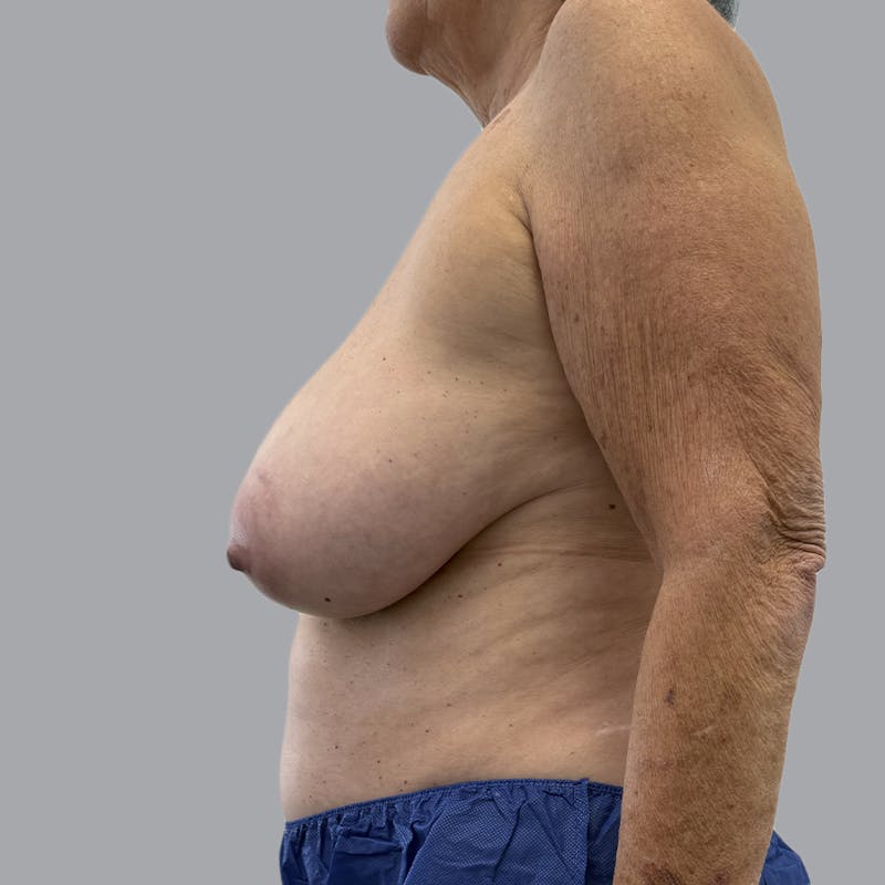 Breast Reduction Before & After Gallery - Patient 126012 - Image 3