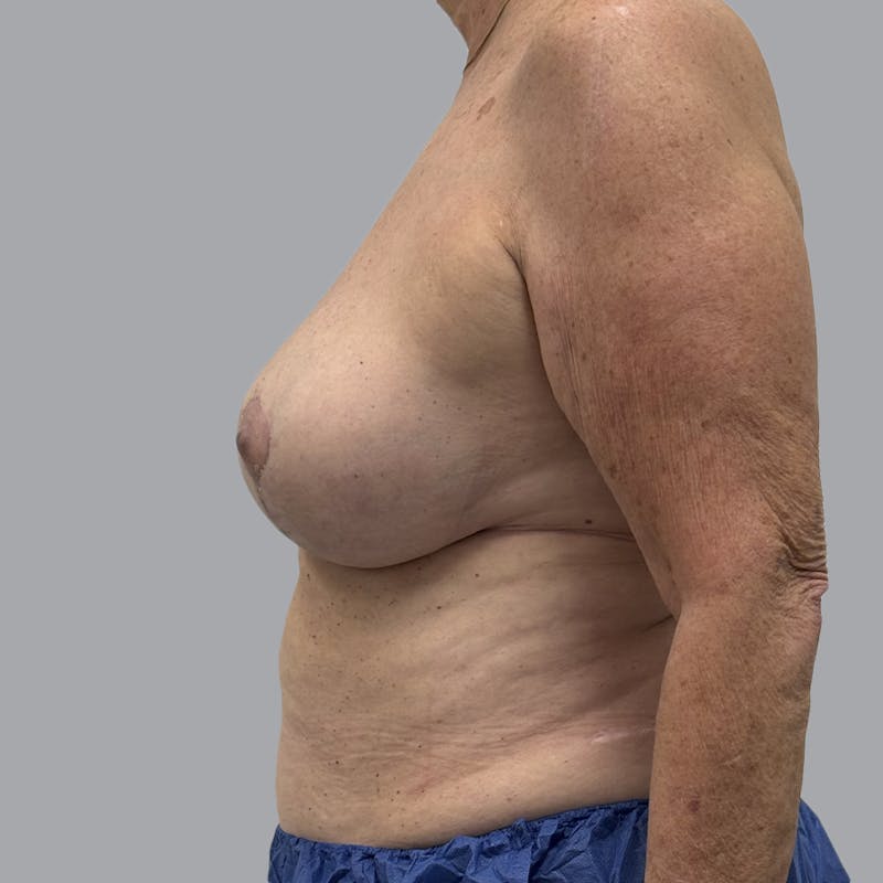 Breast Reduction Before & After Gallery - Patient 126012 - Image 4