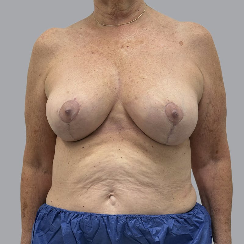 Breast Reduction Before & After Gallery - Patient 126012 - Image 2