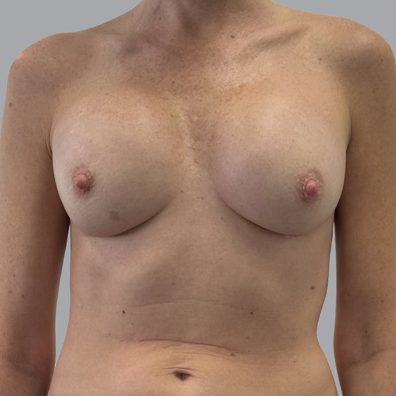 Breast Implant Removal Before & After Gallery - Patient 167667 - Image 1