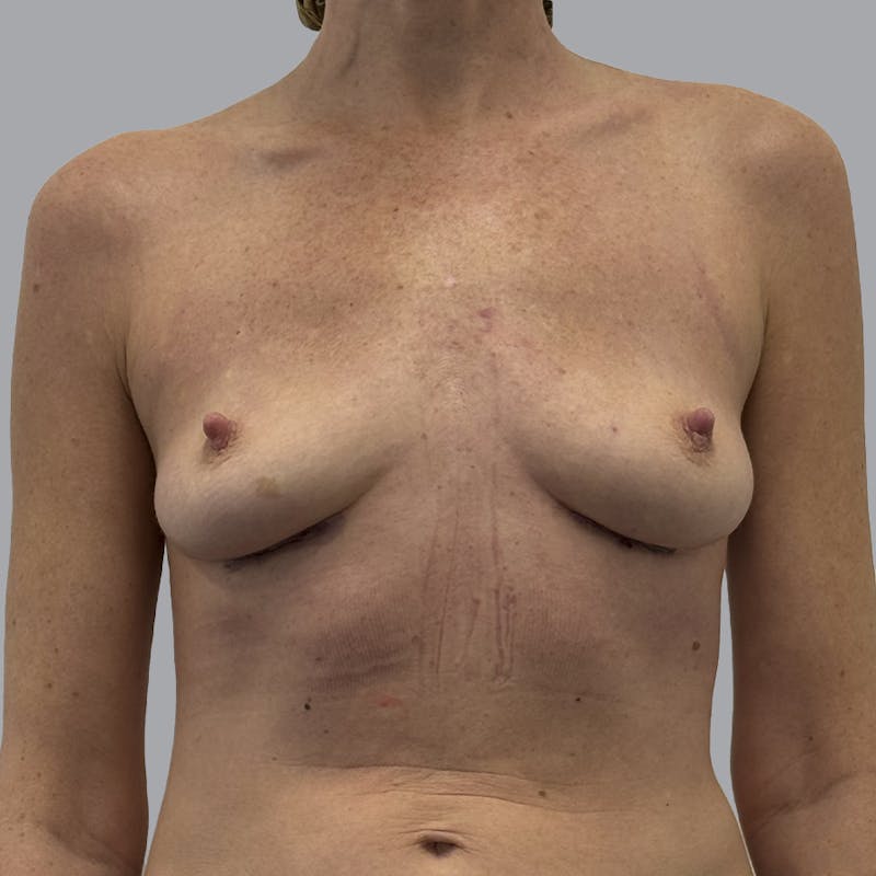 Breast Implant Removal Before & After Gallery - Patient 167667 - Image 2