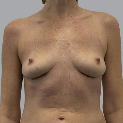 Breast Implant Removal Before & After Gallery - Patient 167667 - Image 2