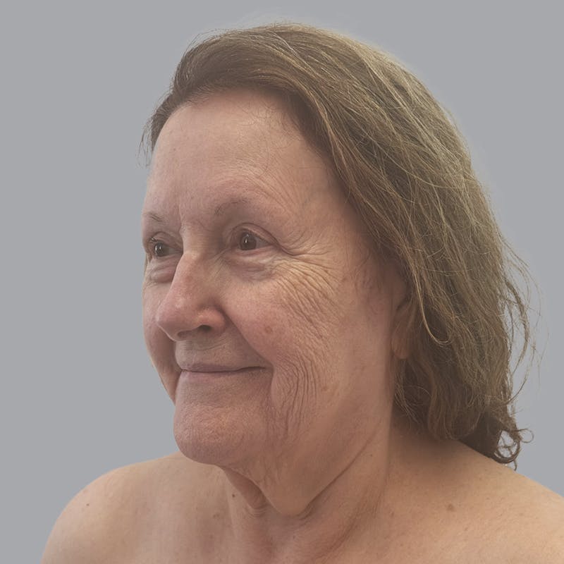 Facelift and Neck Lift Before & After Gallery - Patient 347471 - Image 3
