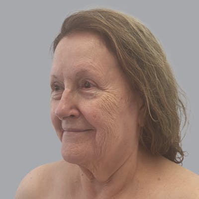 Facelift and Neck Lift Before & After Gallery - Patient 347471 - Image 3