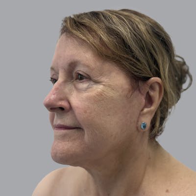 Facelift and Neck Lift Before & After Gallery - Patient 347471 - Image 4